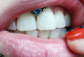 Smiley piercing: la bellezza di piercing nascosto, tutto quello che devi sapere!