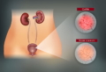 Come curare la cistite senza antibiotico: sintomi, cause e metodi per contrastarla in modo naturale!