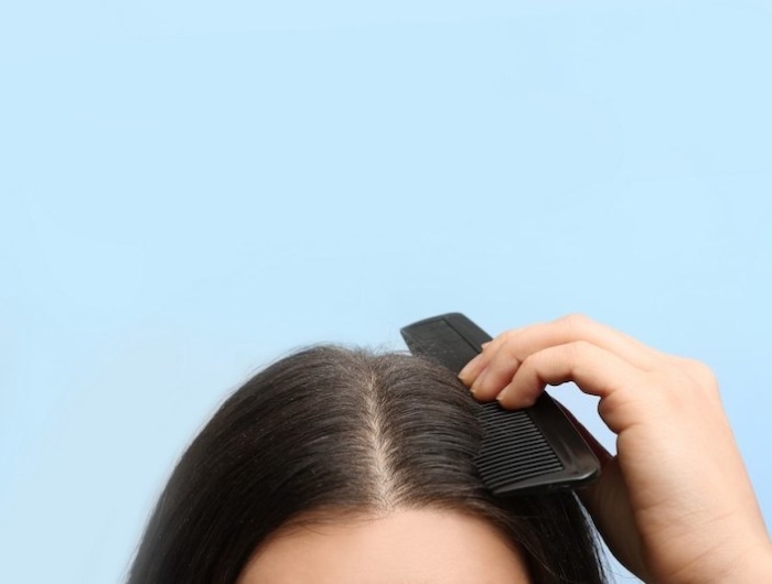 Come eliminare la forfora affidandosi a metodi sicuri e trucchetti casalinghi!