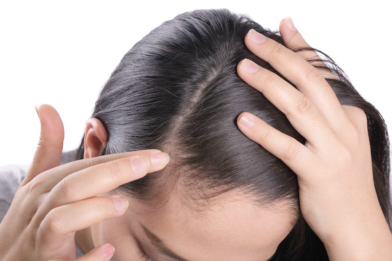 alopecia femminile e trattamenti