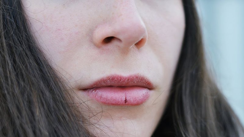 trattamento labbra screpolate con vitamina e pura