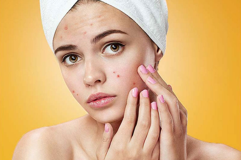 trattamento dell' acne con lo zenzero
