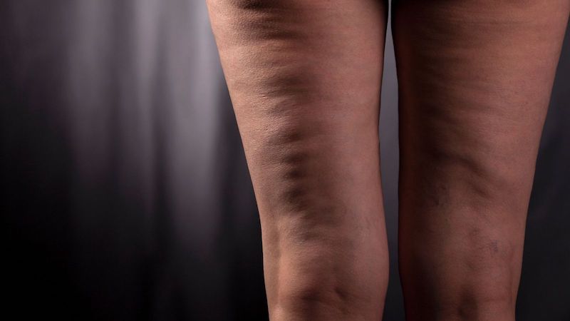 gambe femminili con cellulite ritenzione idrica