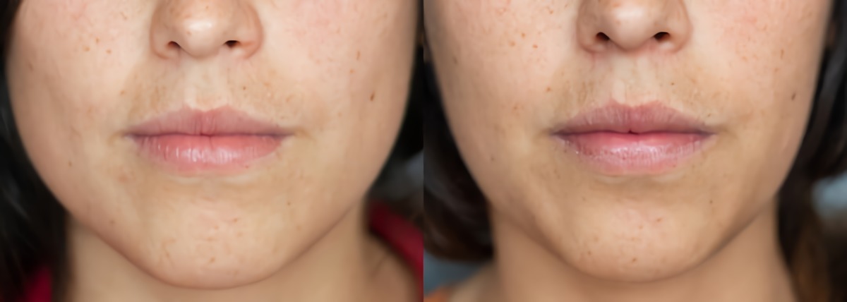 prima e dopo iniezioni botox viso donna