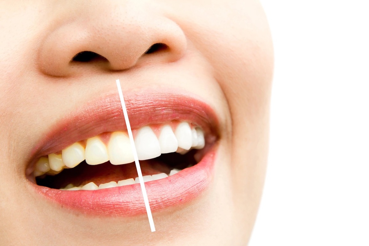 effetti positivi doccia dentale denti bianchi